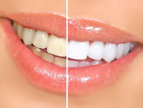 Teeth Whitening
